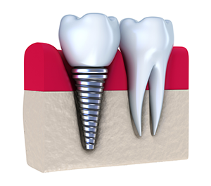 illustration of tooth in gums next to dental implant Woburn, MA